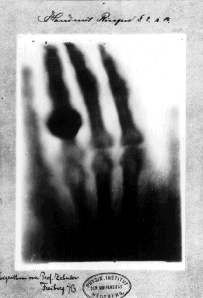 An x-ray of a hand with a large bulge on the ring finger